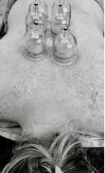 Dry Needling & Vacuum Cupping