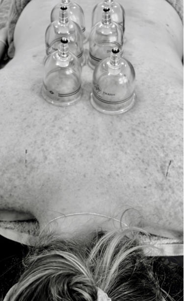 Dry Needling & Vacuum Cupping