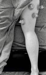 Dry Needling & Vacuum Cupping