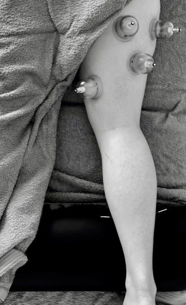 Dry Needling & Vacuum Cupping
