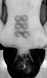 Dry Needling & Vacuum Cupping