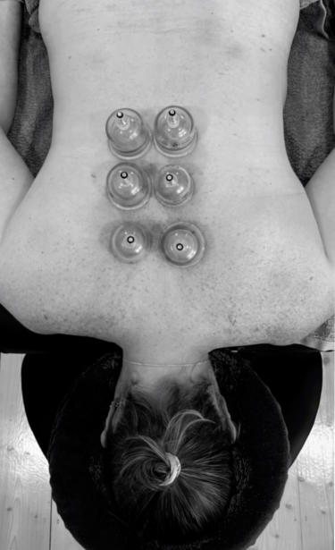 Dry Needling & Vacuum Cupping
